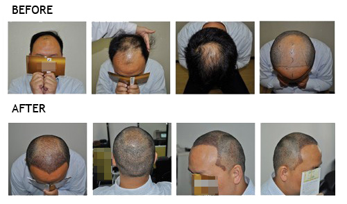 Hair Transplant in YONO, in China — An Affordable and Quality Cosmetic Care