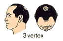 3 vertex